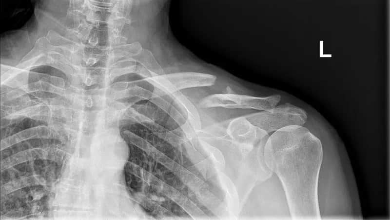 Ile trwa rehabilitacja po złamaniu obojczyka? Poznaj kluczowe czynniki